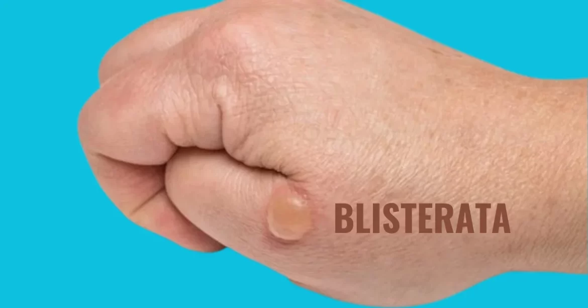 Deciphering Blisterata: Causes, Treatment, Prevention